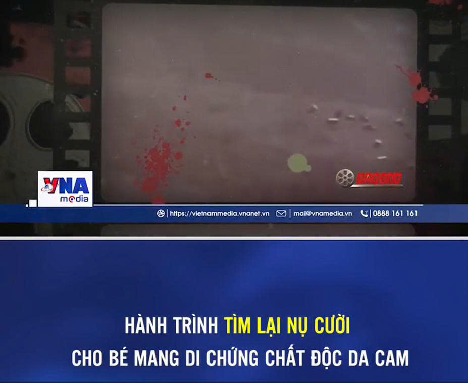 HÀNH TRÌNH TÌM LẠI NỤ CƯỜI CHO BÉ MANG DI CHỨNG CHẤT ĐỘC DA CAM